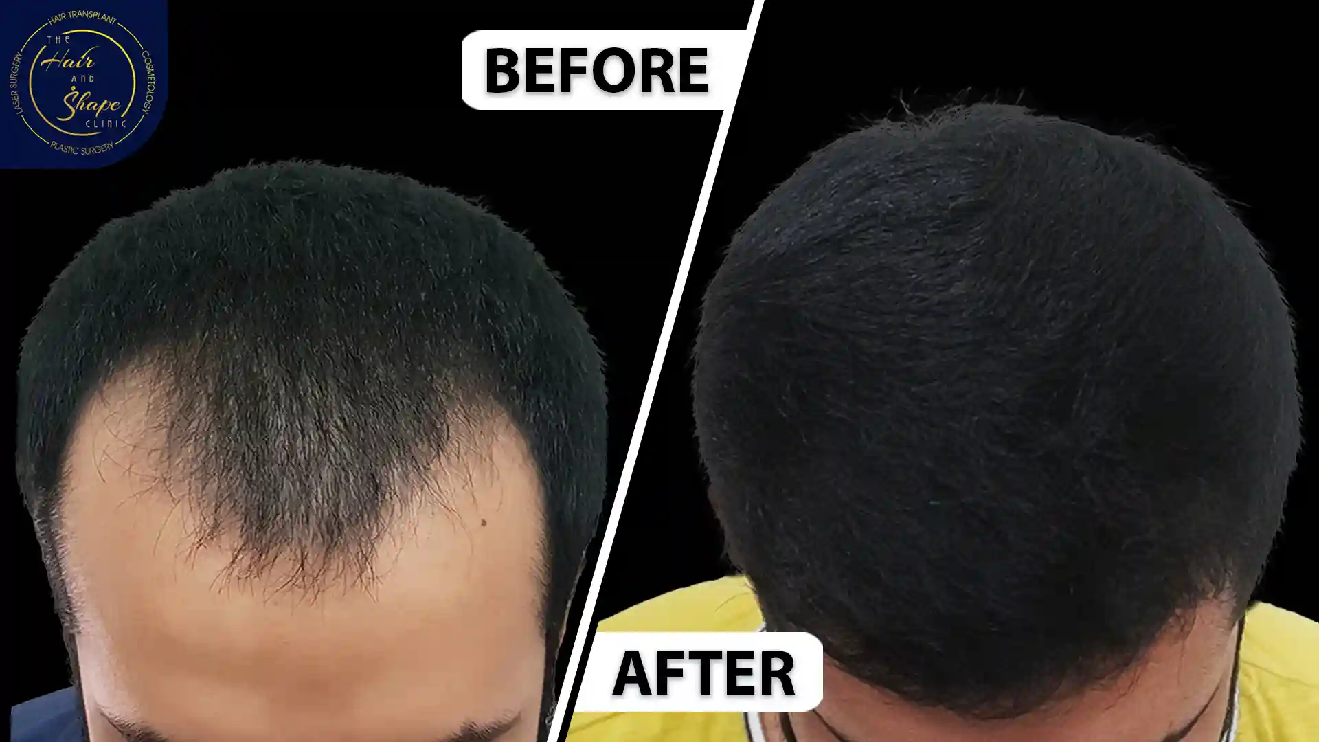 Hair Transplant result15